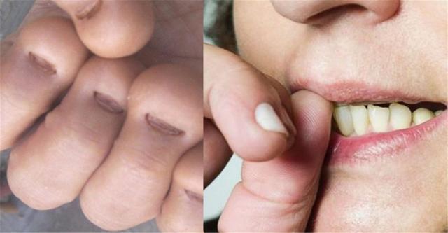 为啥孩子总爱咬指甲专家坦言可能是心理疾病家长要注意