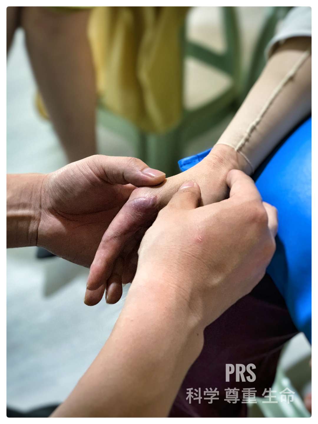 普瑞仕:烧伤瘢痕康复专业手法牵伸讲座