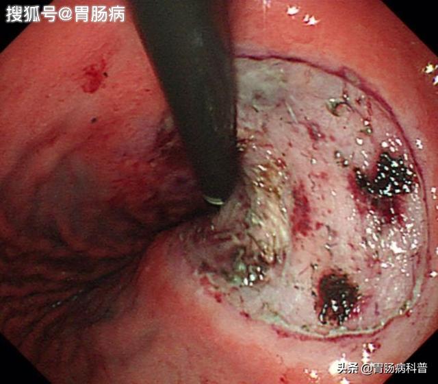 胃癌晚期胃镜图片图片