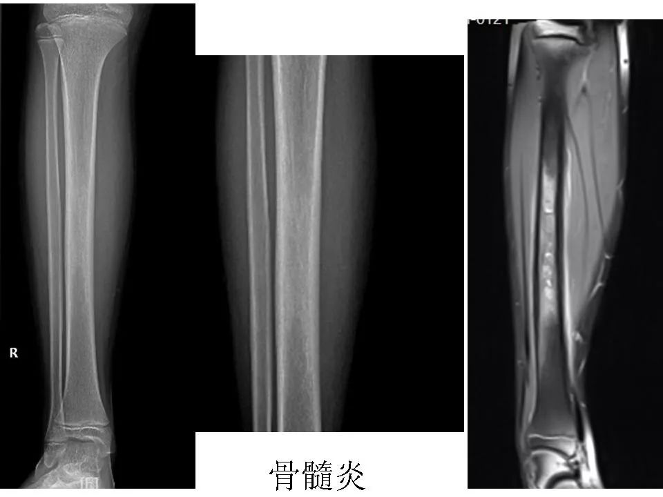 长骨嗜酸性肉芽肿的影像诊断影像天地