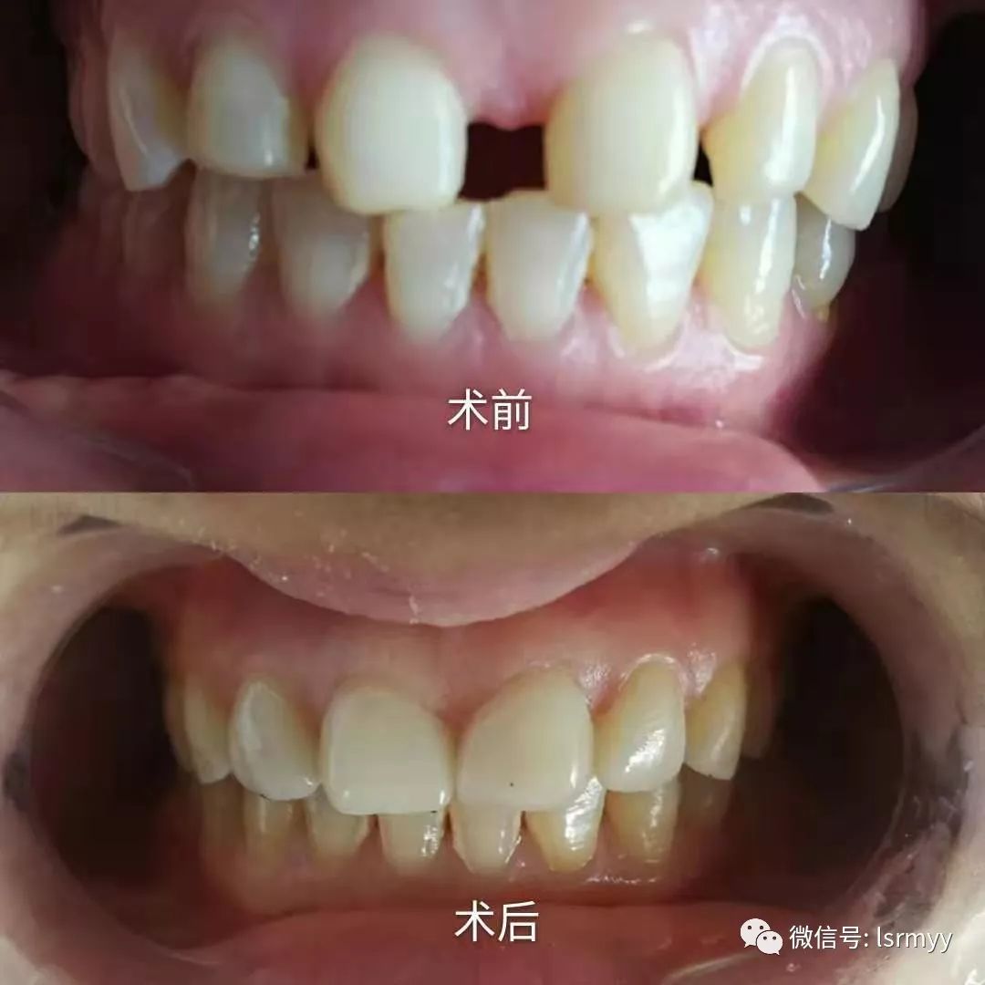 痛苦?难堪?——快来县人民医院口腔科做个超薄微创美白贴面吧!