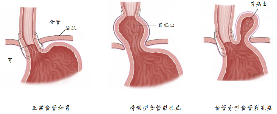 什么是食管裂孔疝如何微创治疗董擂教授科普系列