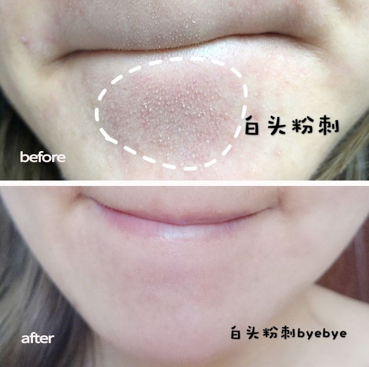 下巴闭口小白头揉一揉全带走去下巴闭口顽固黑头用它揉一揉轻松"拔"光
