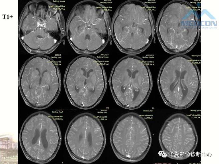 病毒性脑炎的mri诊断