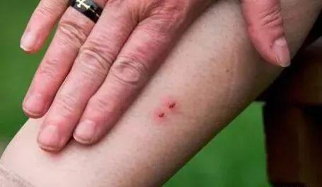 今早一男子在小区草丛被毒蛇咬伤跑医院找血清未果这些人为他揪心