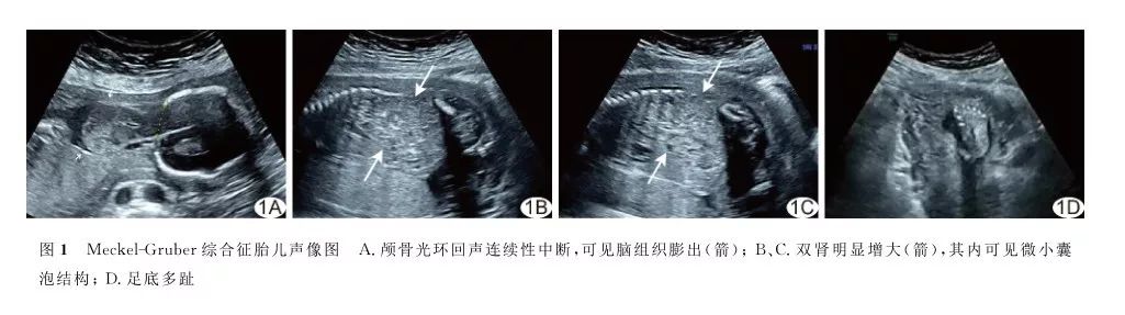 臨床上在早孕晚期可通過超聲確診,主要所見為擴大的囊性腎臟,腦膨出或