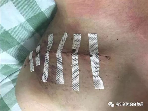 粉碎性骨折南寧一男子騎車時被施工鋼板絆倒究竟是誰的責任