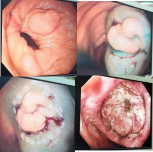 微创新动态西青医院普外团队肠镜下全麻巧除患者直肠肿瘤