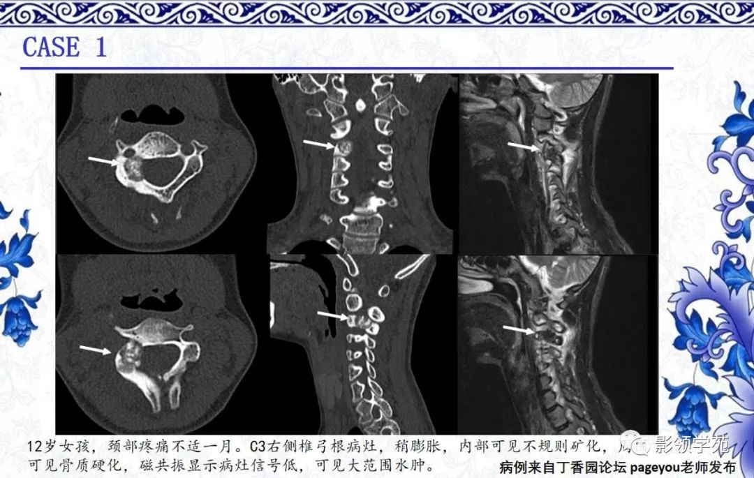 经典常见骨源性肿瘤的影像表现