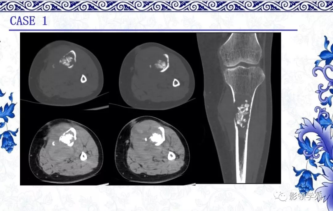 经典常见骨源性肿瘤的影像表现