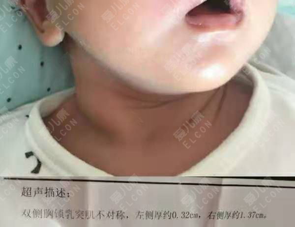宝宝脖子有个筋包图片图片
