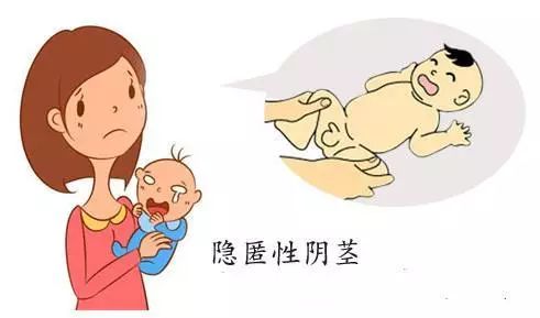 隐匿阴茎是肉膜发育异常所致的一种常见的先天发育异常和畸形性疾病