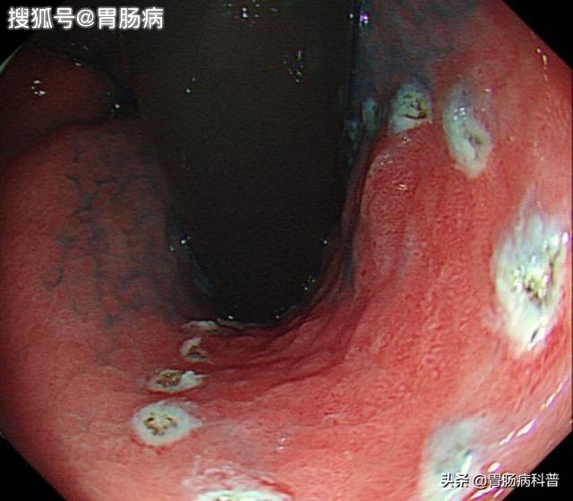 胃溃疡的图片真实照片图片