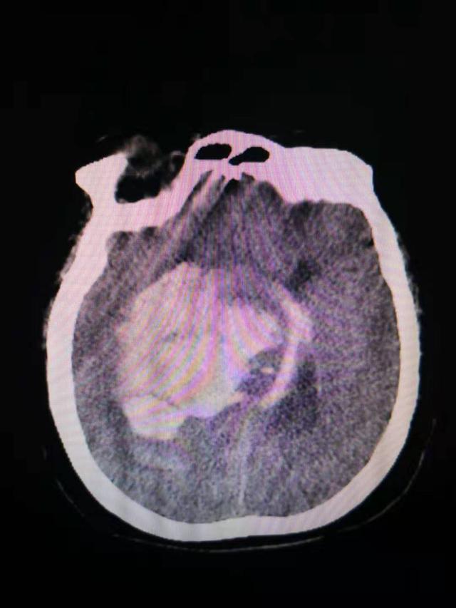 圖,排除急性心肌梗死,後做了頭顱ct,提示:大面積右側腦出血,腦疝形成