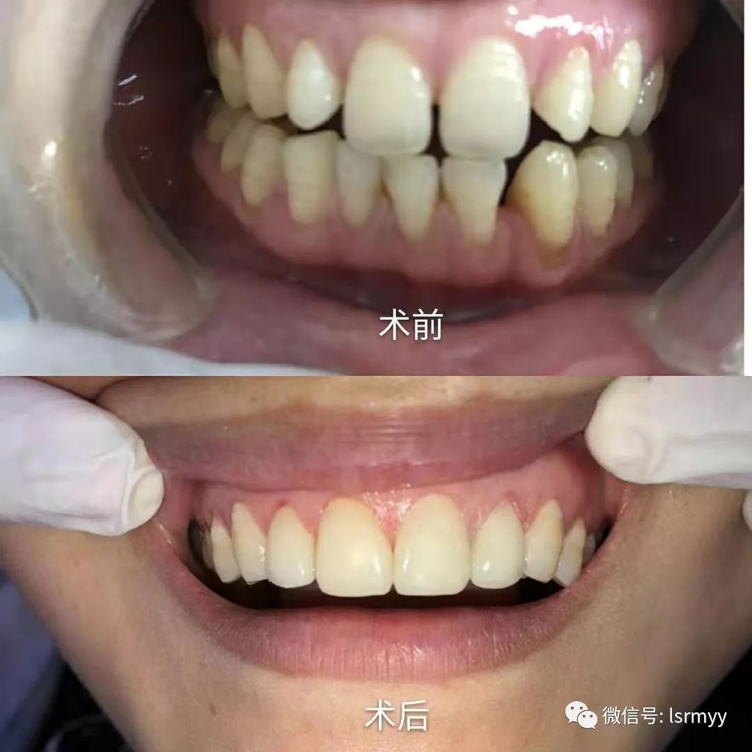 贴面前后对比图二