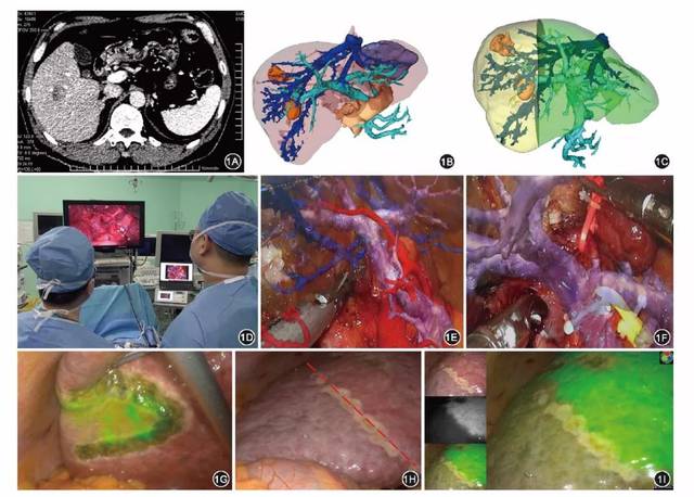 方驰华增强现实导航技术联合吲哚菁绿分子荧光影像在三维腹腔镜肝切除