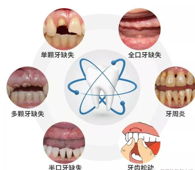 每个人都可以做种植牙吗?_缺失