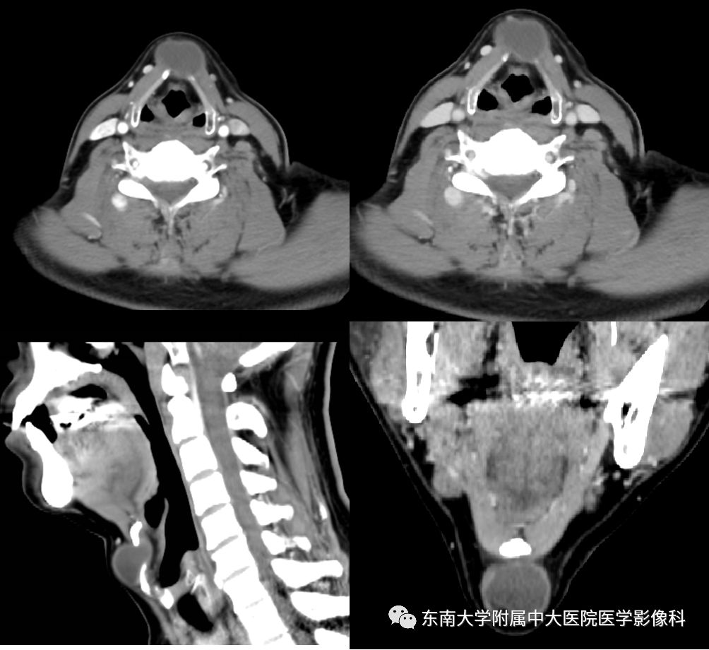 異位甲狀腺和甲狀舌管囊腫的影像表現