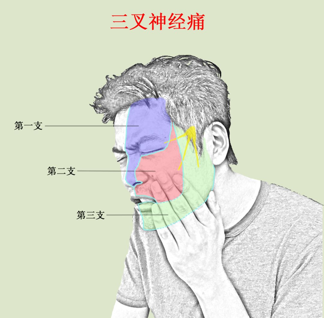 典型的三叉神经痛大多为单侧发病,发病时通常没有预兆,疼痛历时数秒至