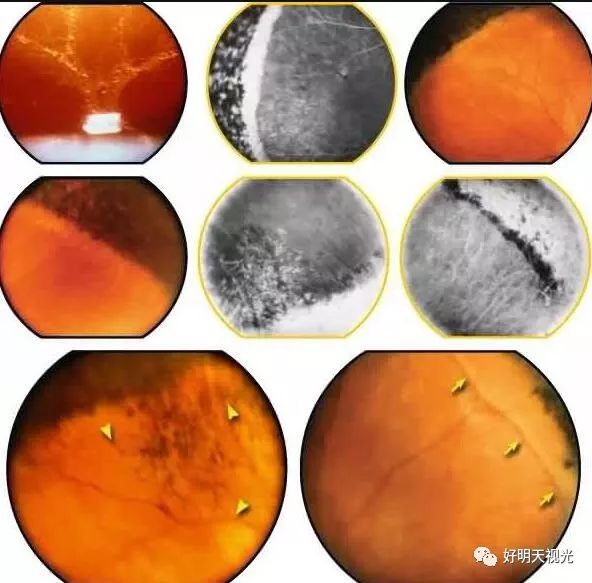 高度近视常见并发症有哪些?