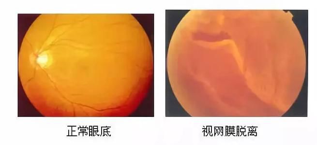 【愛眼護眼】視網膜脫離危害大 正確認識早預防_玻璃體