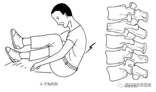腰椎骨折功能锻炼图片图片