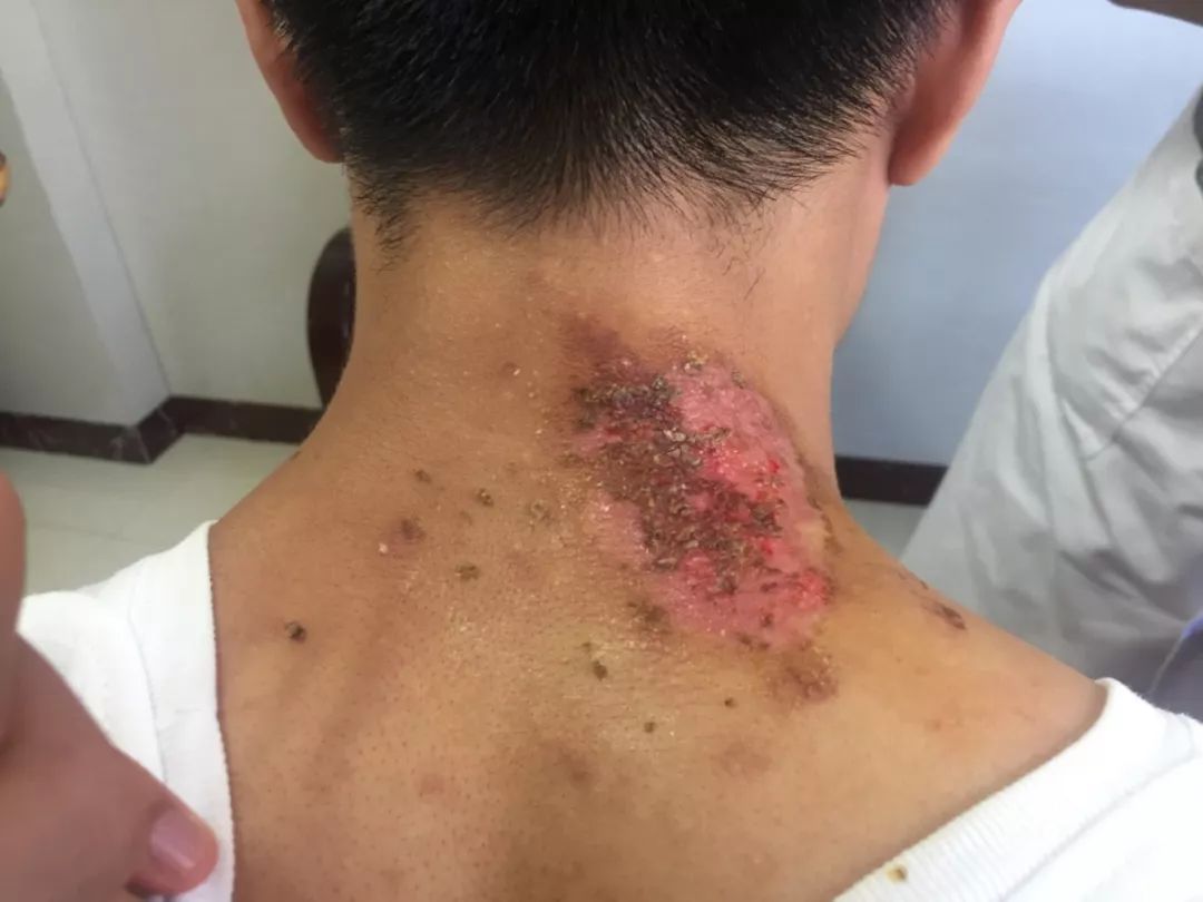 吓人夏天遇到这种虫子千万不能拍已有多人中招进医院