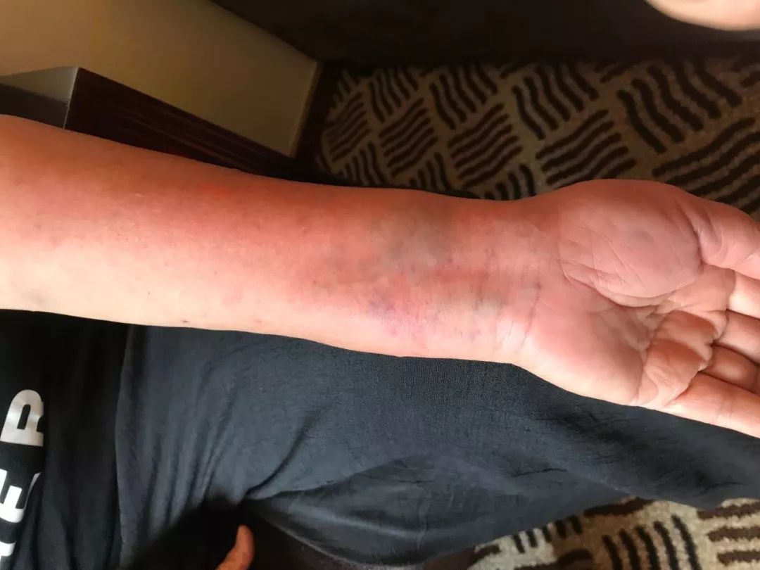 神门穴,位于手腕关节手掌侧,尺侧腕屈肌腱的桡侧凹陷处.