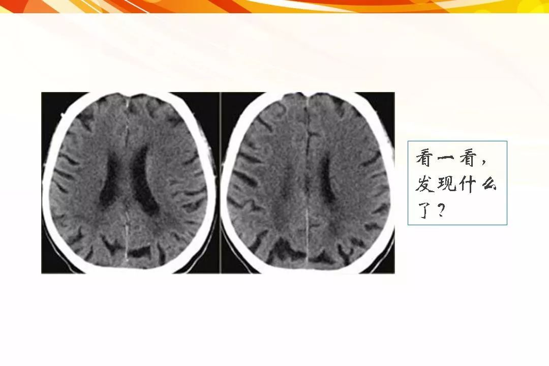 腦缺血急性腦梗死的影像學表現影像天地