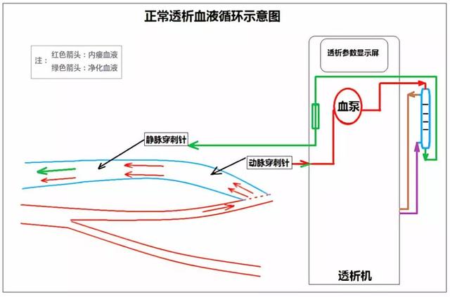 医生护士我的内瘘血流量不足是怎么回事呢