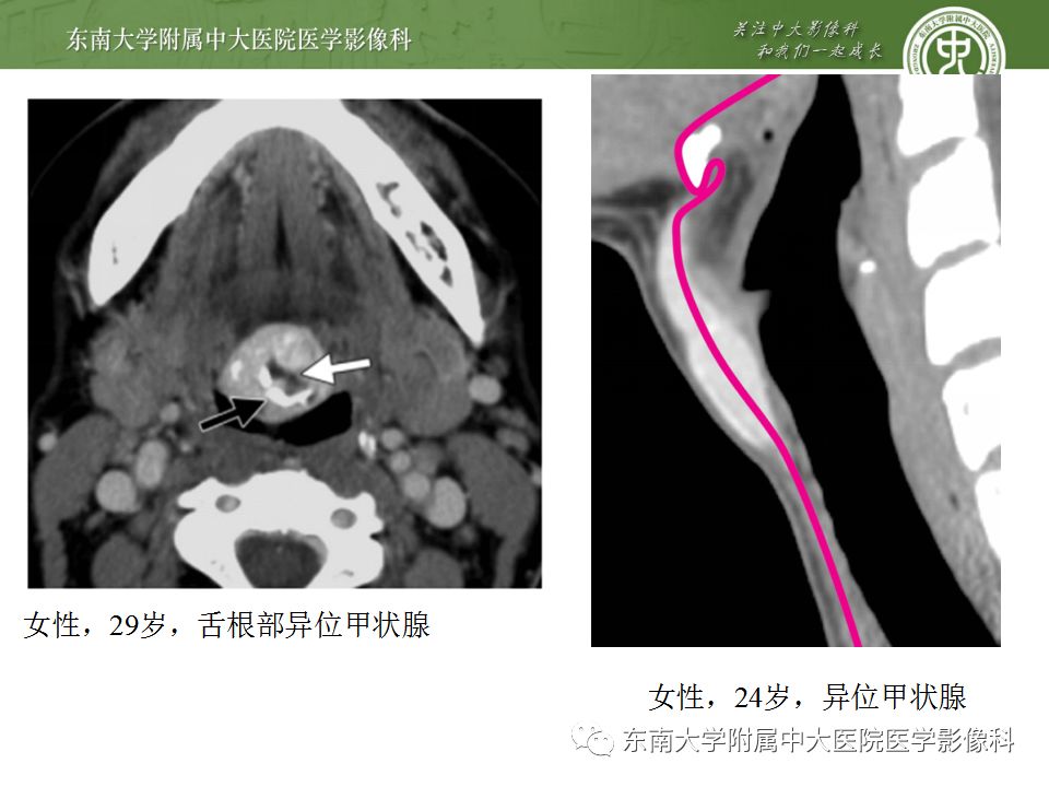 異位甲狀腺和甲狀舌管囊腫的影像表現