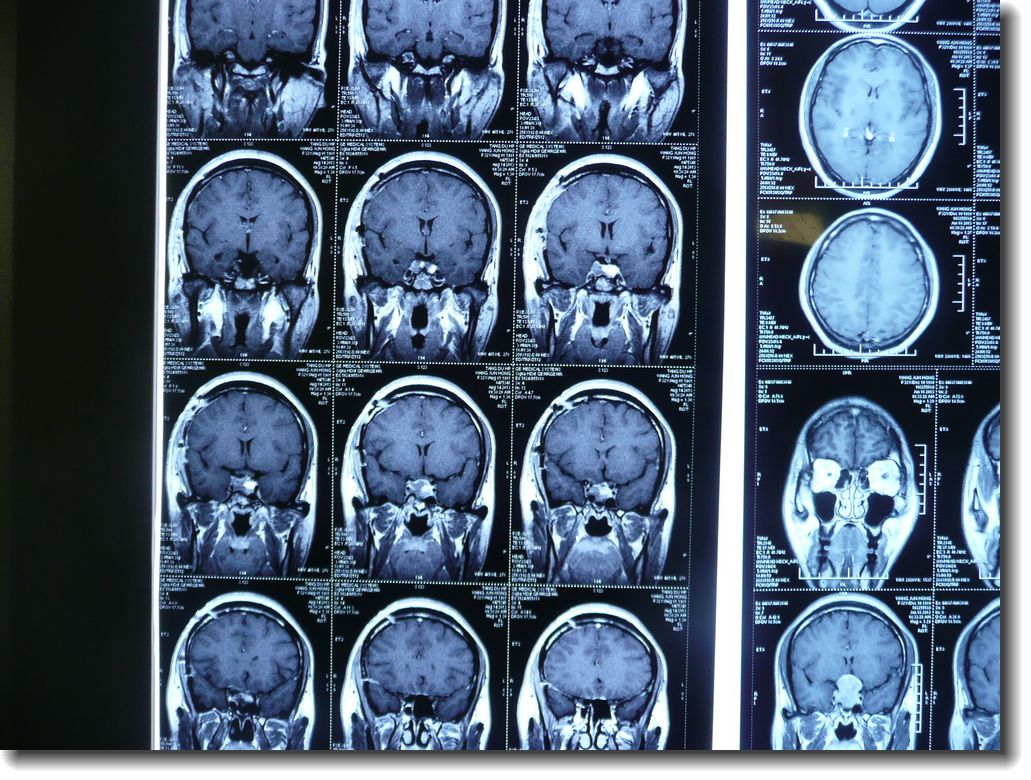 贺晓生教授手术回放——垂体瘤开颅手术