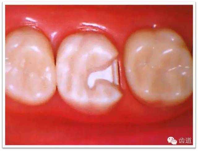 鸠尾固位形钉洞固位形沟固位形箱型固位形桩固位形(增加固位形和抗力