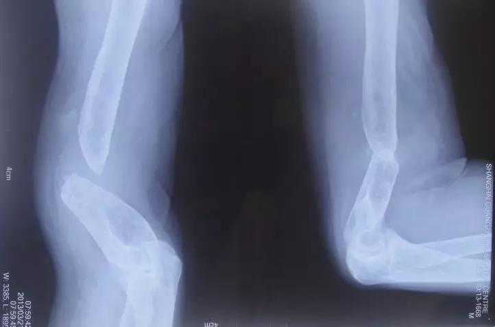 骨不连的诊断和治疗方法上海六院陈华科普系列