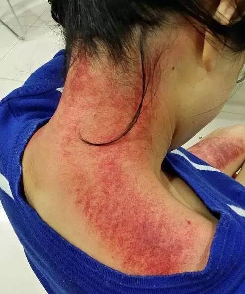 刮痧并非愈痛愈有效,也不是刮得又黑又紫才好