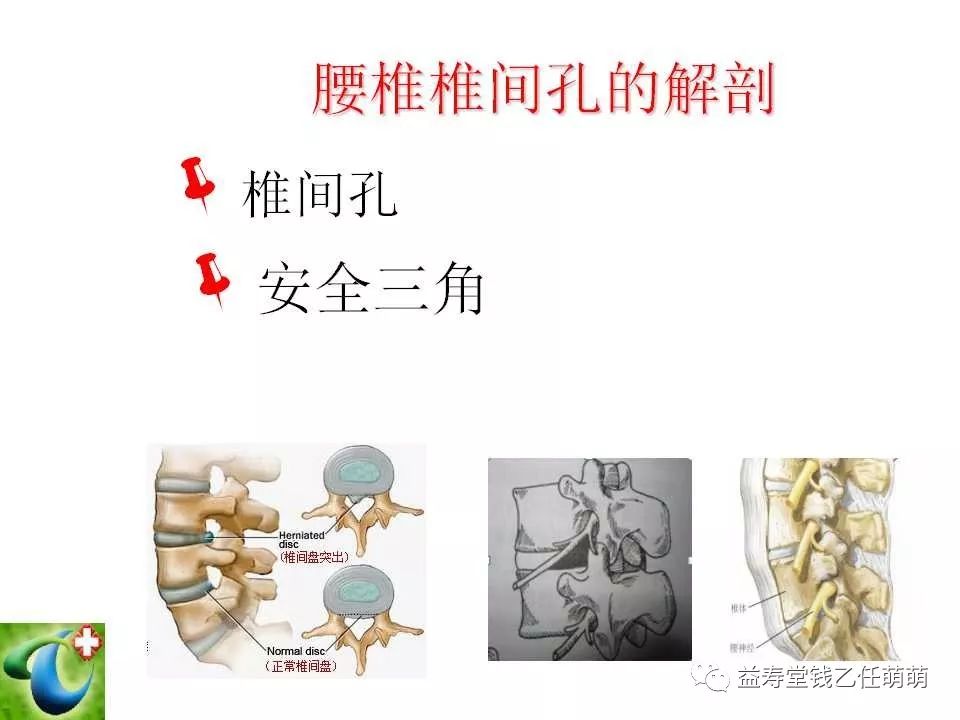 侧隐窝阻滞术进针点图片