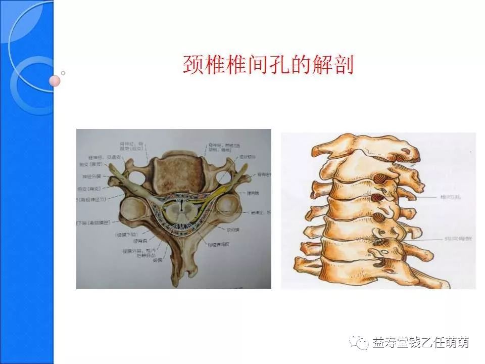 侧隐窝和椎间孔区别图片