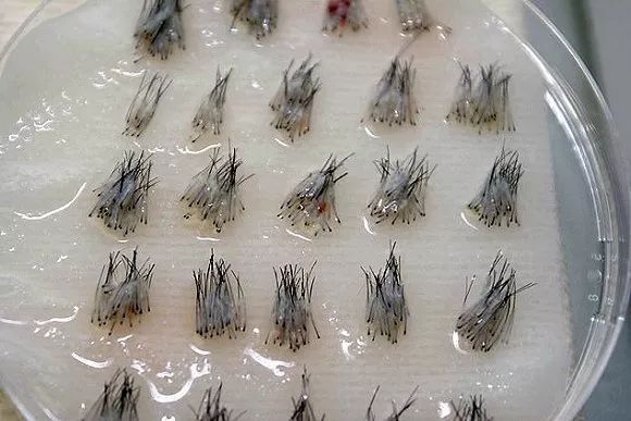 脱发人士的福音英国首家头发银行推出毛囊细胞移植服务