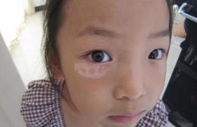 原创儿童为什么会患上白癜风?
