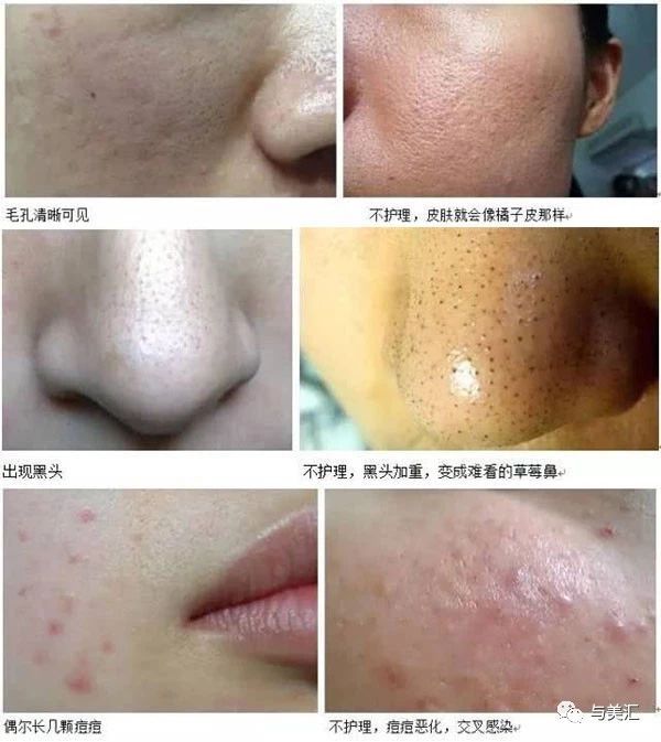 74皮肤呈现橘皮样皮脂腺分泌旺盛,过剩的油脂堆积在毛囊里使毛孔