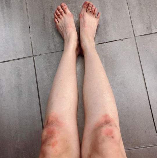 腿太细的女生受伤图片