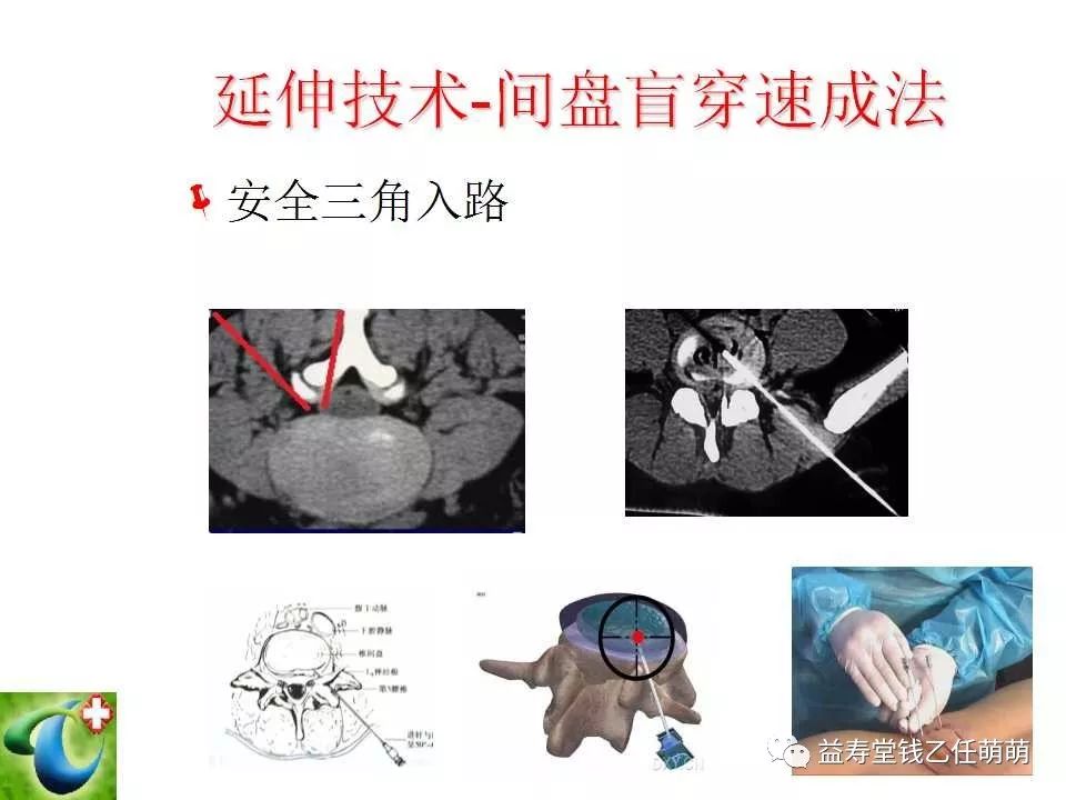 椎间孔注射方法步骤图片