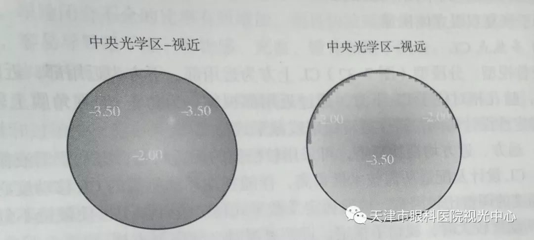 天津市眼科医院视光中心张姝贤主任:多焦点软性接触镜矫正老视的验配