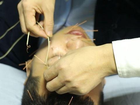 口眼歪斜漱口漏水得了面瘫速速去针灸