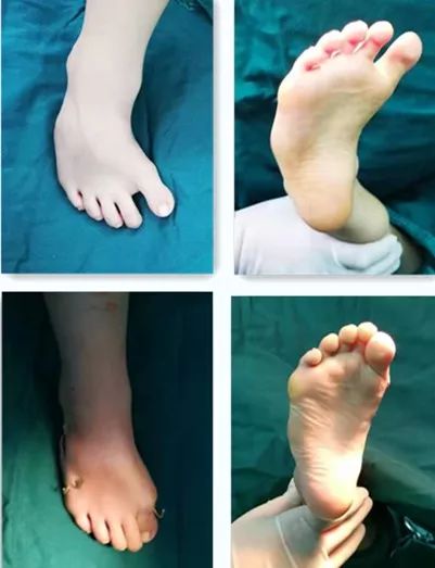 马蹄足患儿的守护神骨科开展多项儿童畸形足矫治新技术