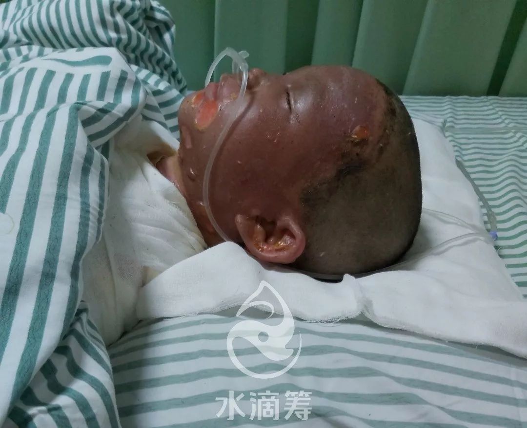 涡阳城东一农户煤气罐泄露,引发爆燃,6岁男孩为救爷爷被烧惨!_孩子