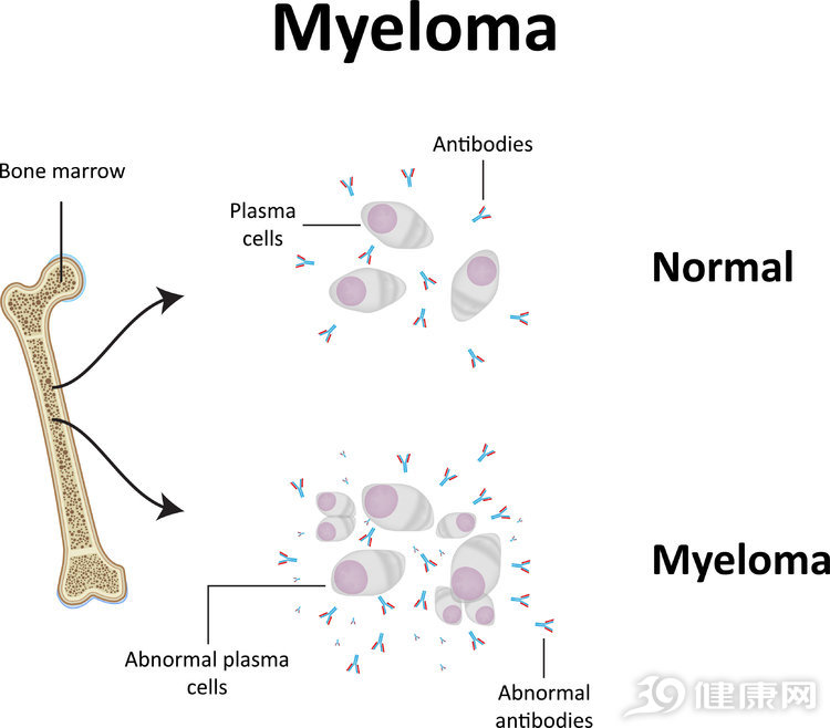 原創最麻煩的就是血液病得了多發性骨髓瘤5個症狀比較難熬