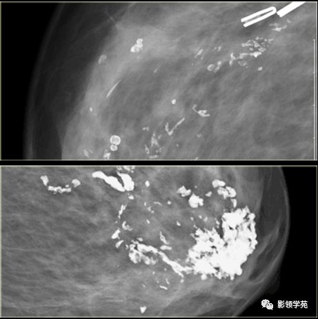 乳腺钙化的鉴别诊断与分级