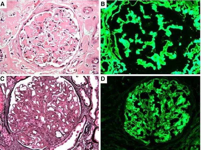 副蛋白相关肾小球疾病