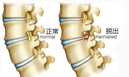 腰椎管狭窄症与腰椎间盘突出症有什么不同 搜狐大视野 搜狐新闻